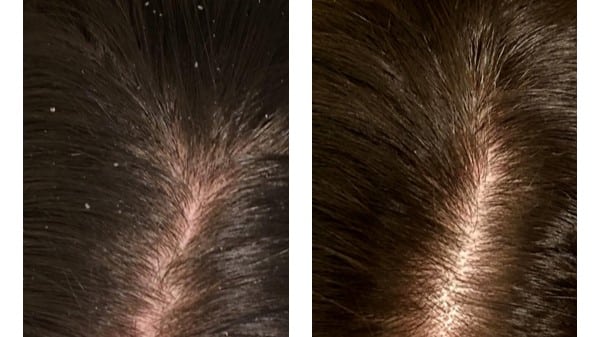Before And After Results Using Davines Purifying Line For Dandruff